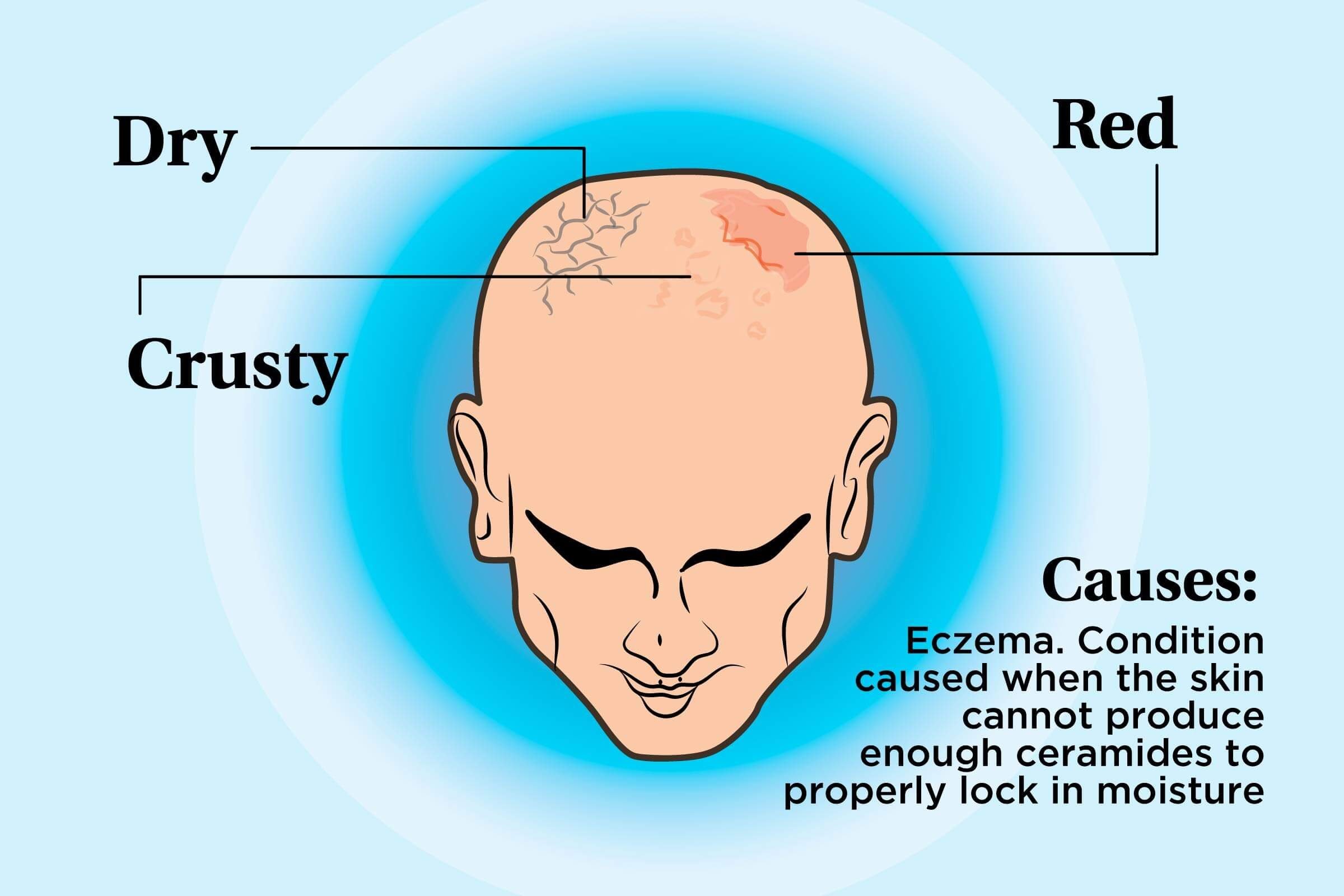 doctors-discuss-alopecia-and-other-conditions-that-need-awareness