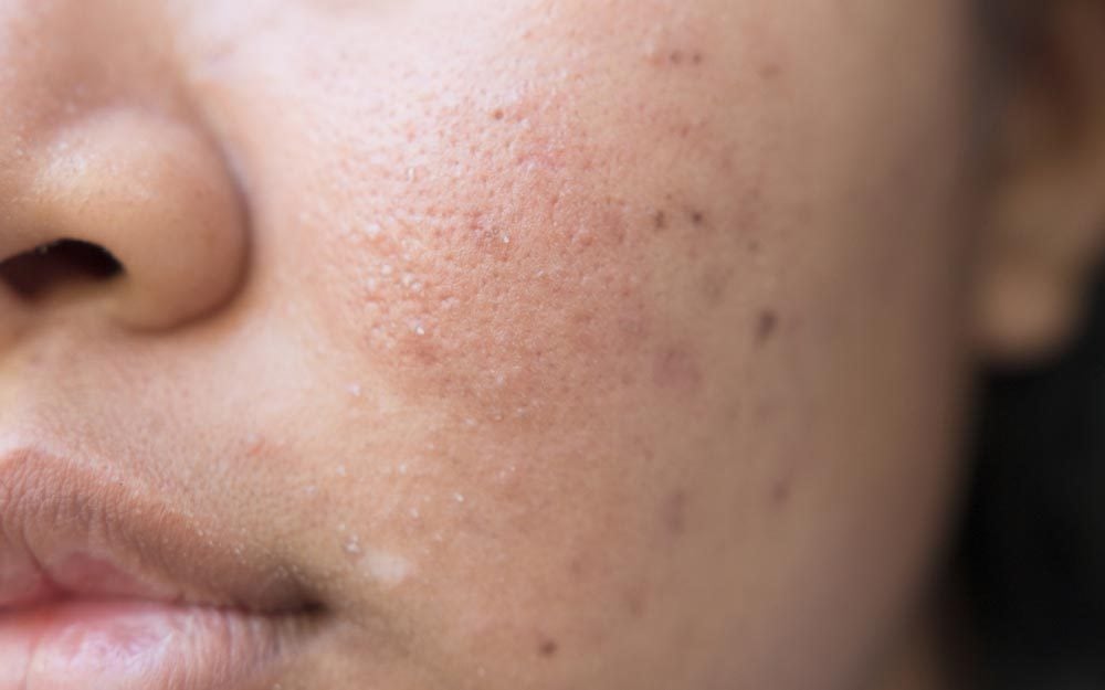 7 Innocent Habits that Can Lead to Acne Scarring