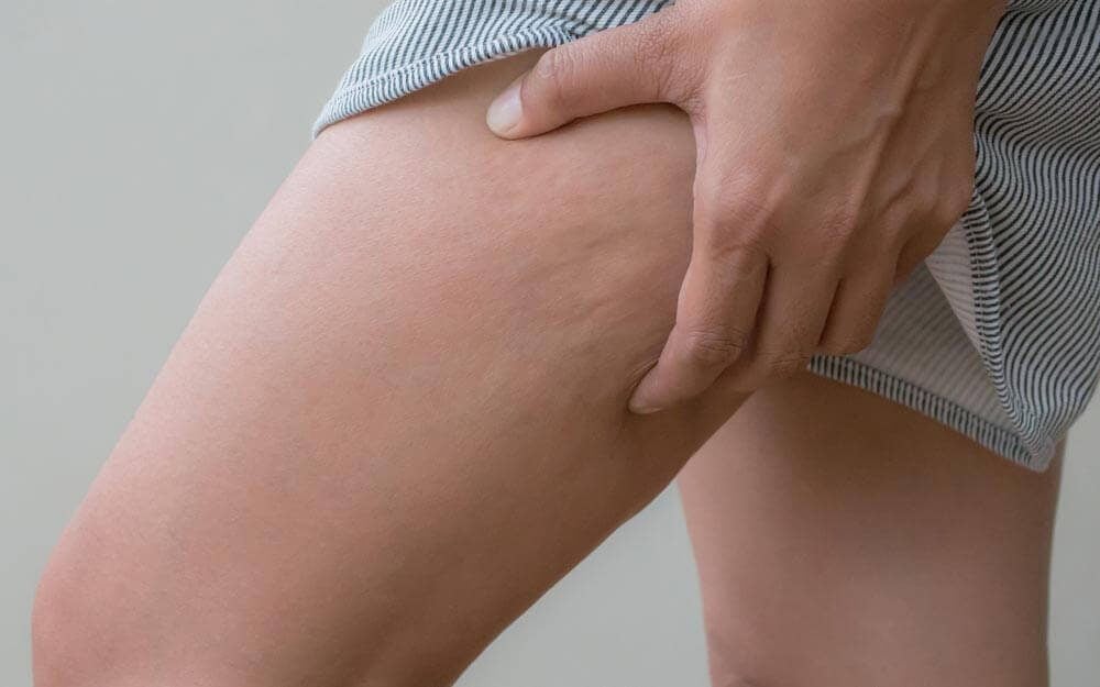The 11 Biggest Myths About Cellulite You Need to Stop Believing