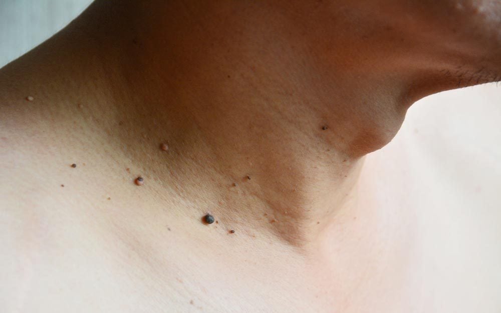 9 Myths About Skin Tags You Need to Stop Believing