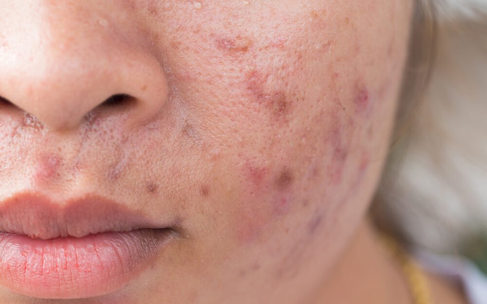 Here’s What Your Acne Breakout Is Actually Telling You