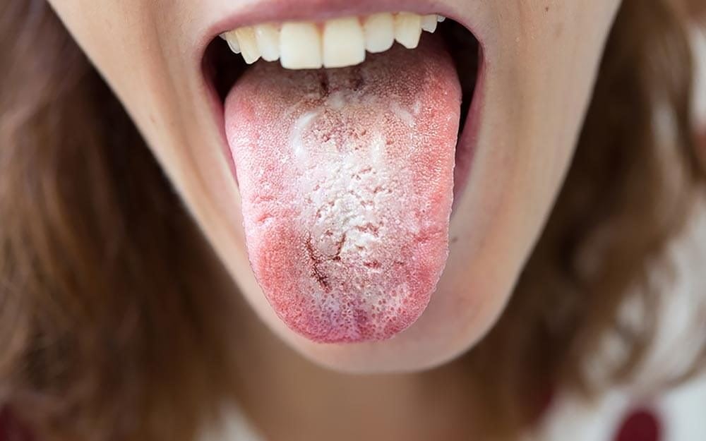 vitamin b12 deficiency symptoms tongue