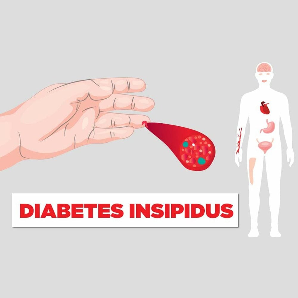 6 Things You Need to Know About Diabetes Insipidus