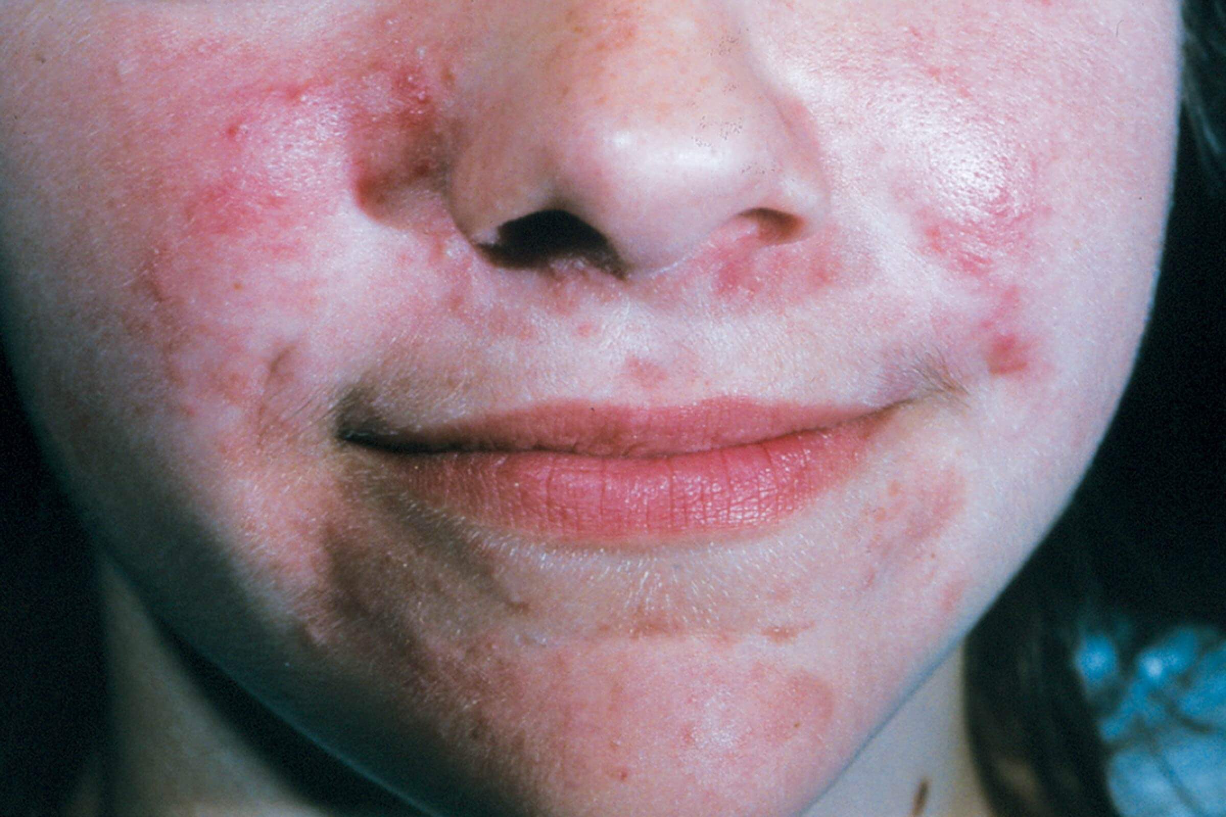 Perioral Dermatitis Heres How To Treat It The Healthy 