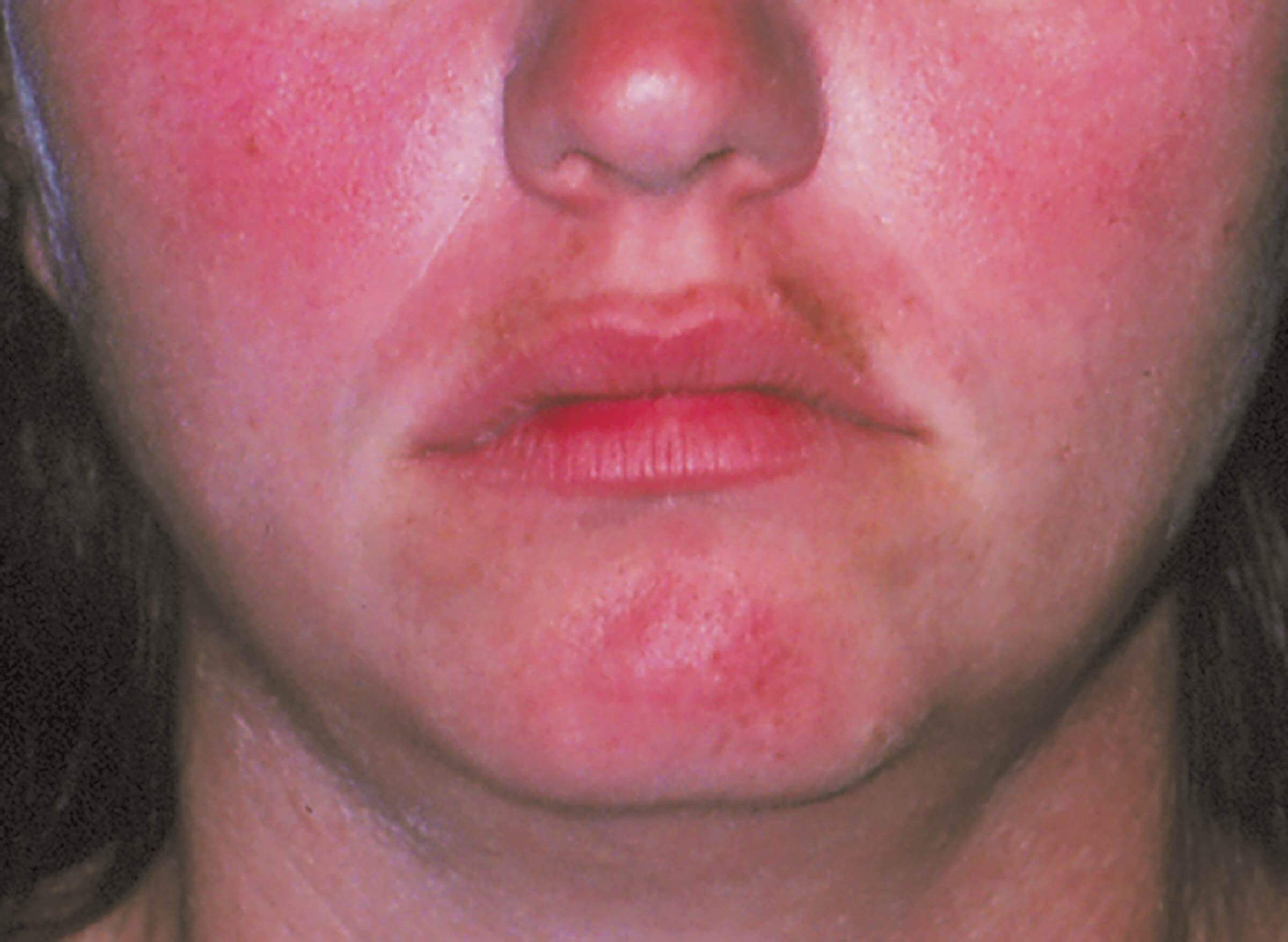 6 Rosacea Treatments that Can Help End Redness