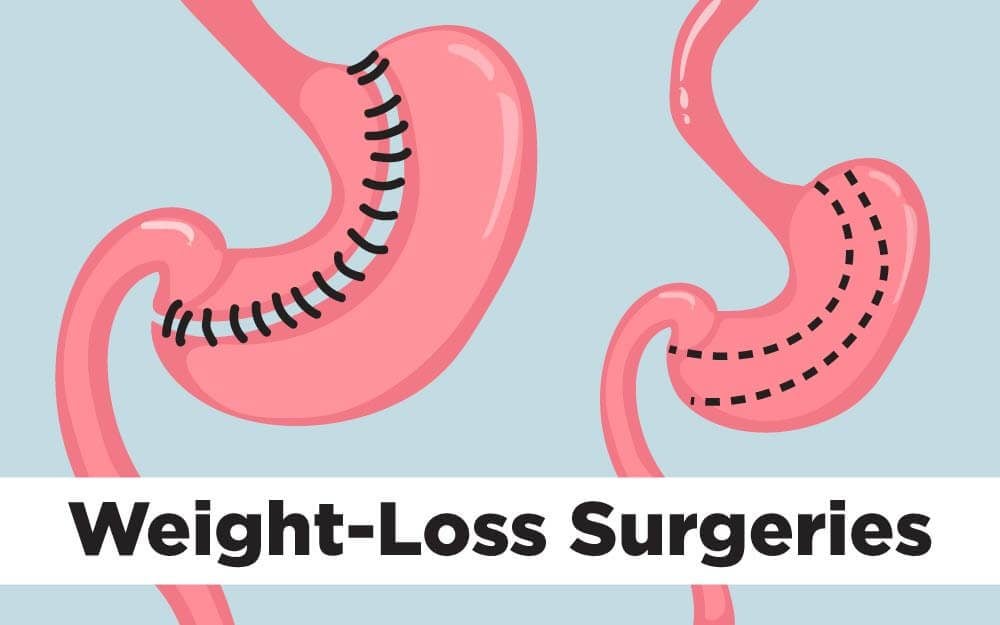 The Top Weight-Loss Surgery Procedures—Ranked and Demystified