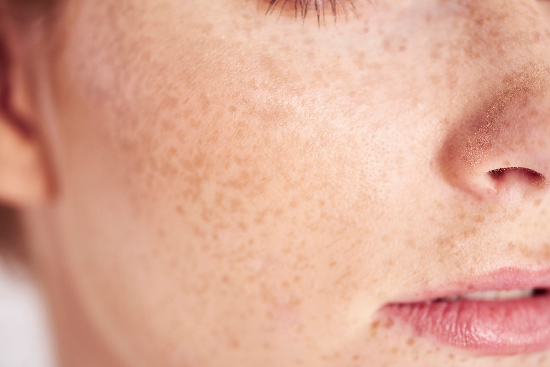 7 Skincare Rules Everyone With Freckles Should Know