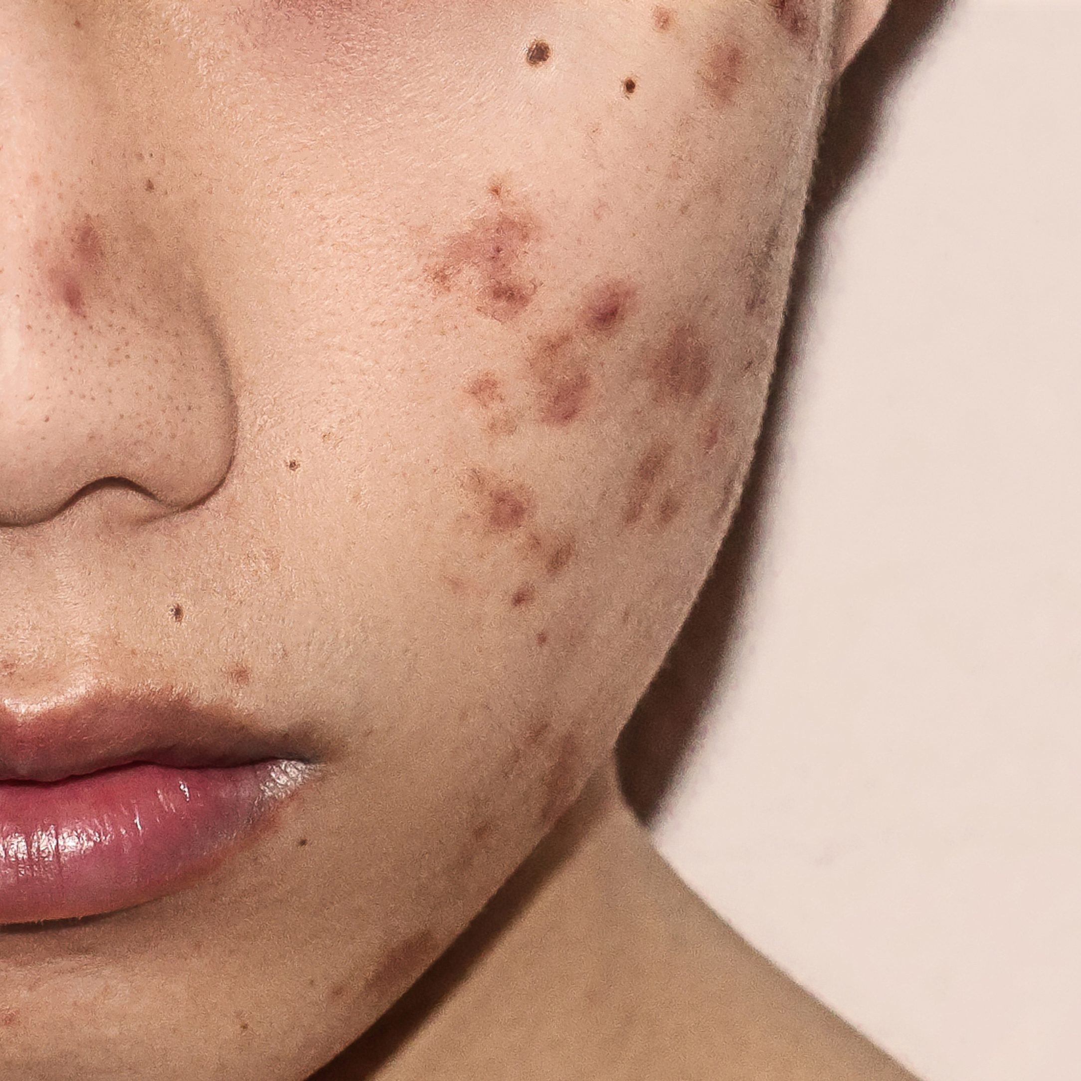 The Best Vitamins for Acne for Clearer, Healthier Skin