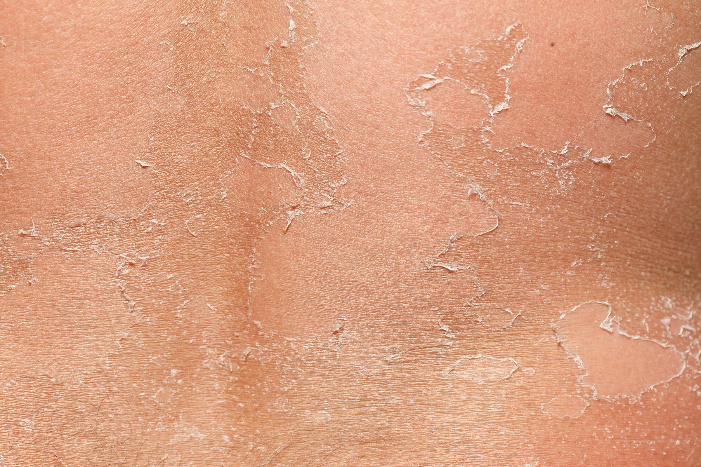 What Your Peeling Skin Is Trying to Tell You