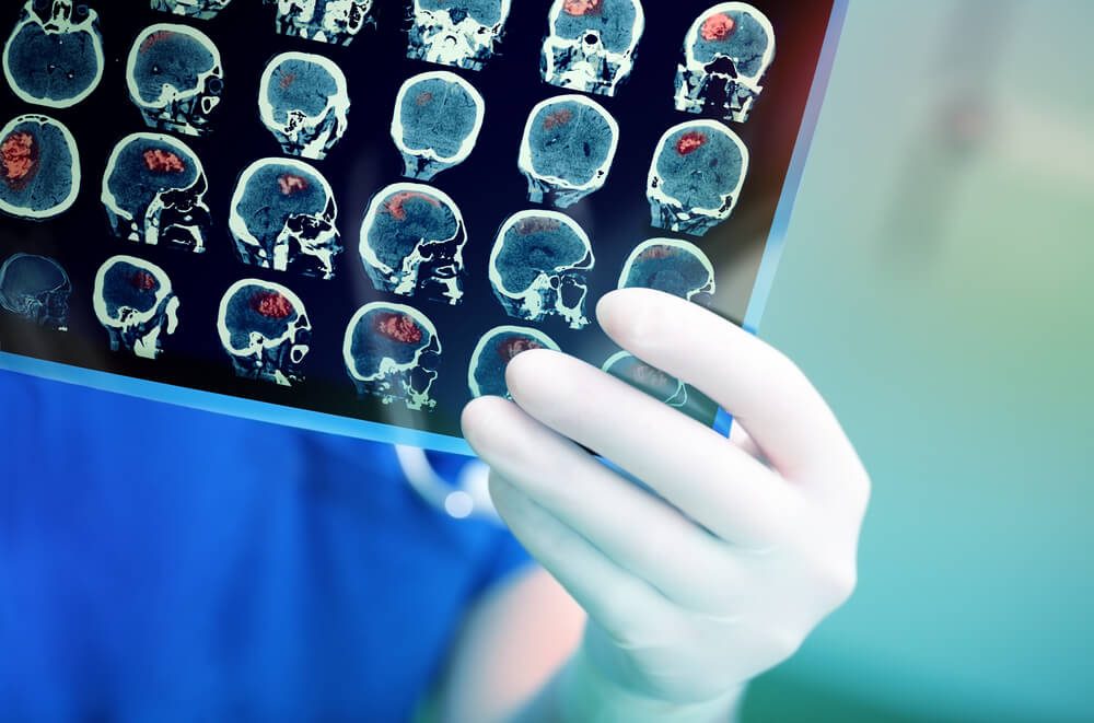 13 Things Neurologists Do to Help Prevent Alzheimer's Disease