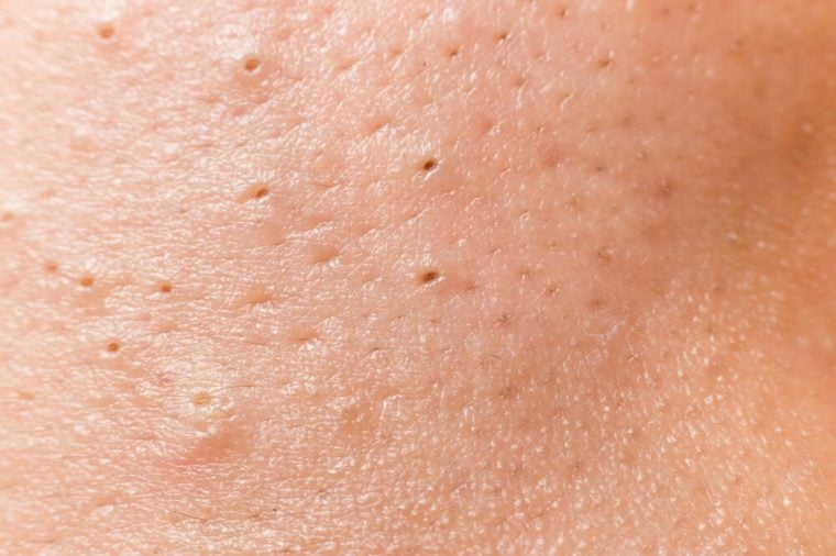 How To Get Rid Of Blackheads 13 Proven Tricks The Healthy