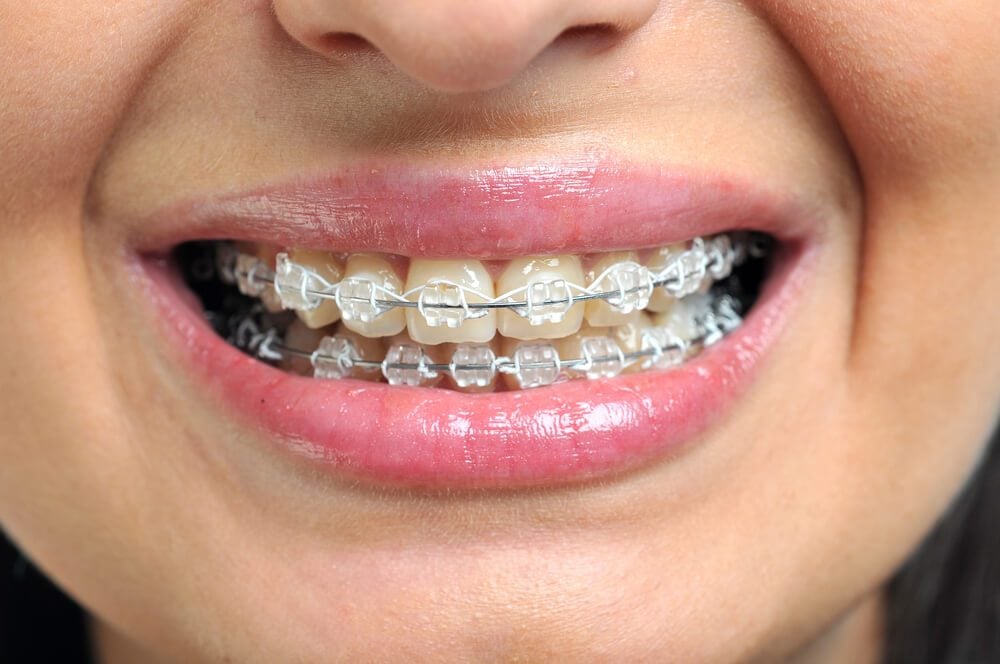 11 Things Your Orthodontist Won't Tell You