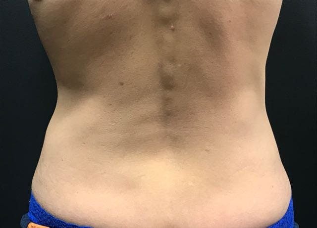 Does CoolSculpting Work? Here's What Happened When I Tried It