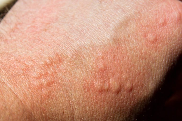 Itchy Skin What It Can Reveal About Your Health The Healthy