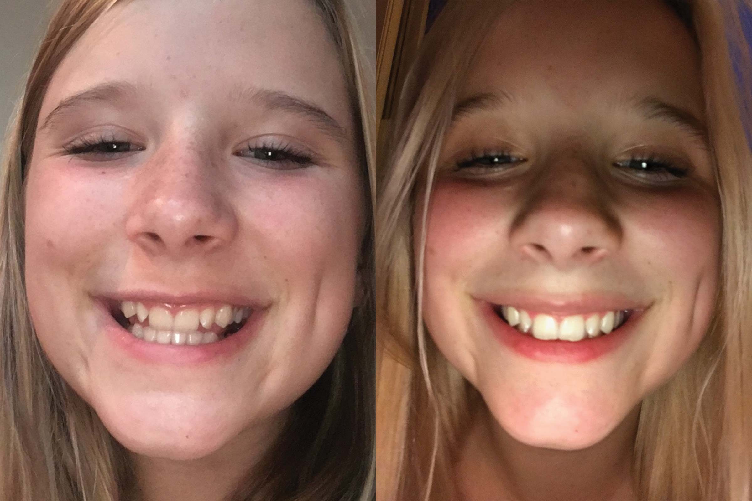 How I Straightened My Teeth Without Braces