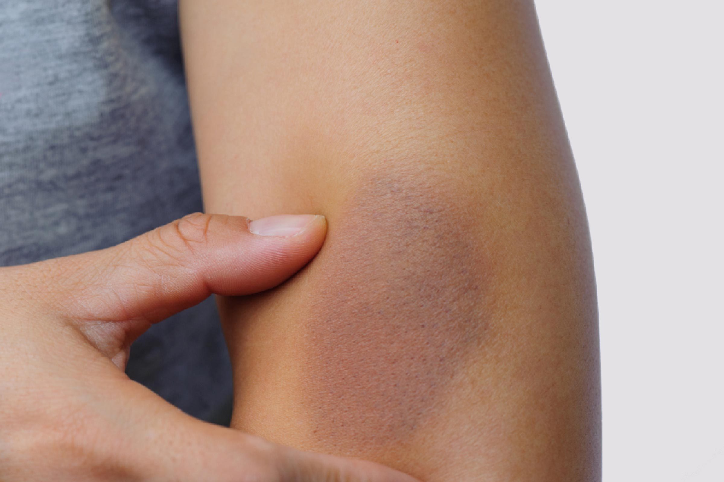 What the Color of Your Bruise Is Trying to Tell You