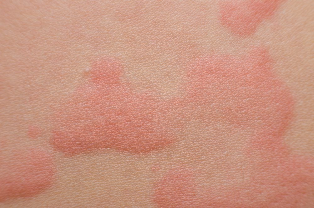 Skin Problems That Could Be A Sign Of Serious Disease The Healthy 