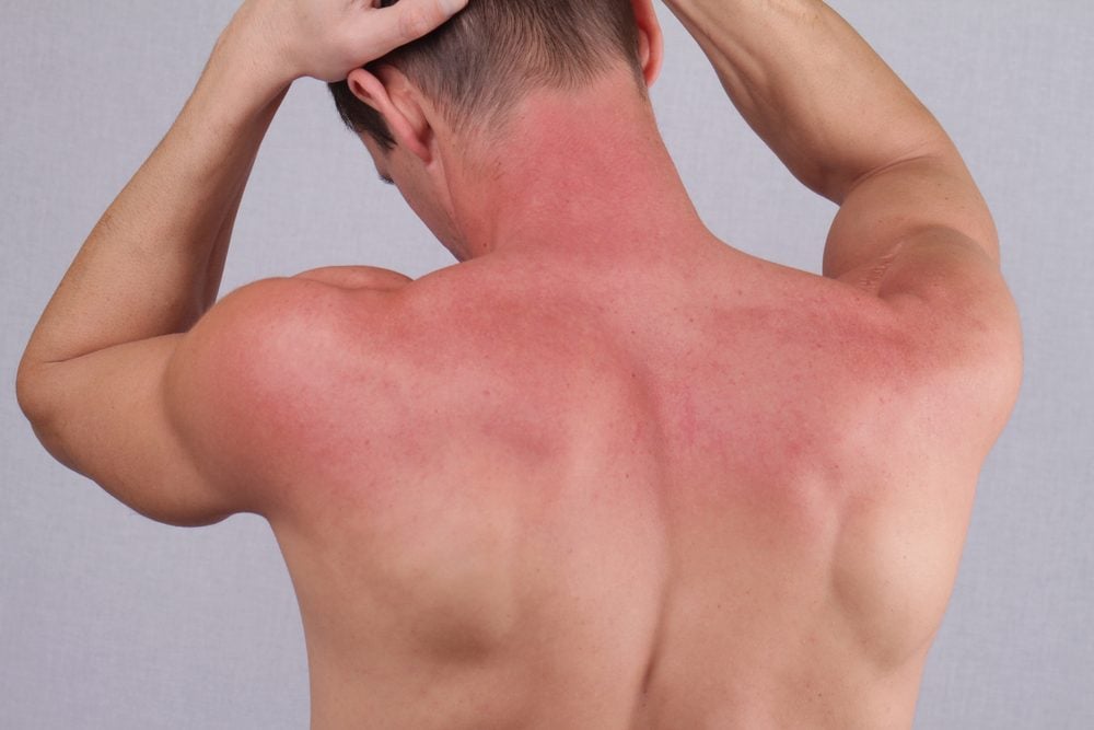 Sunburn Remedies Here S What Dermatologists Do The Healthy