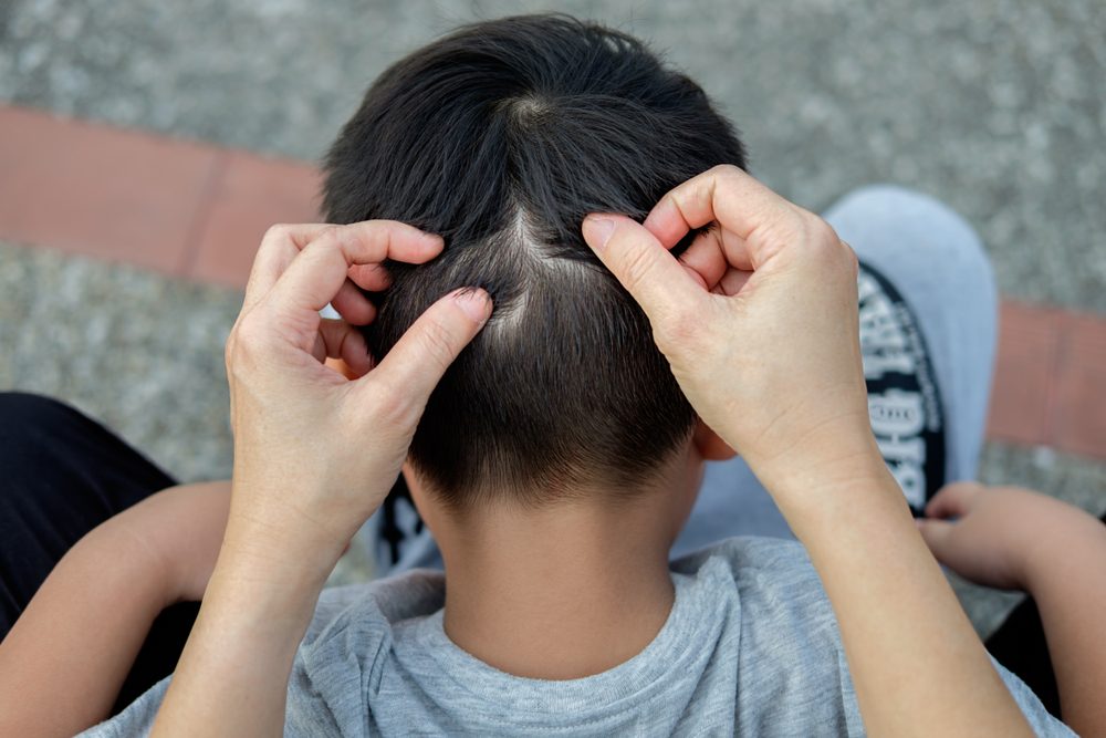14 Expert Tips for How to Get Rid of Head Lice