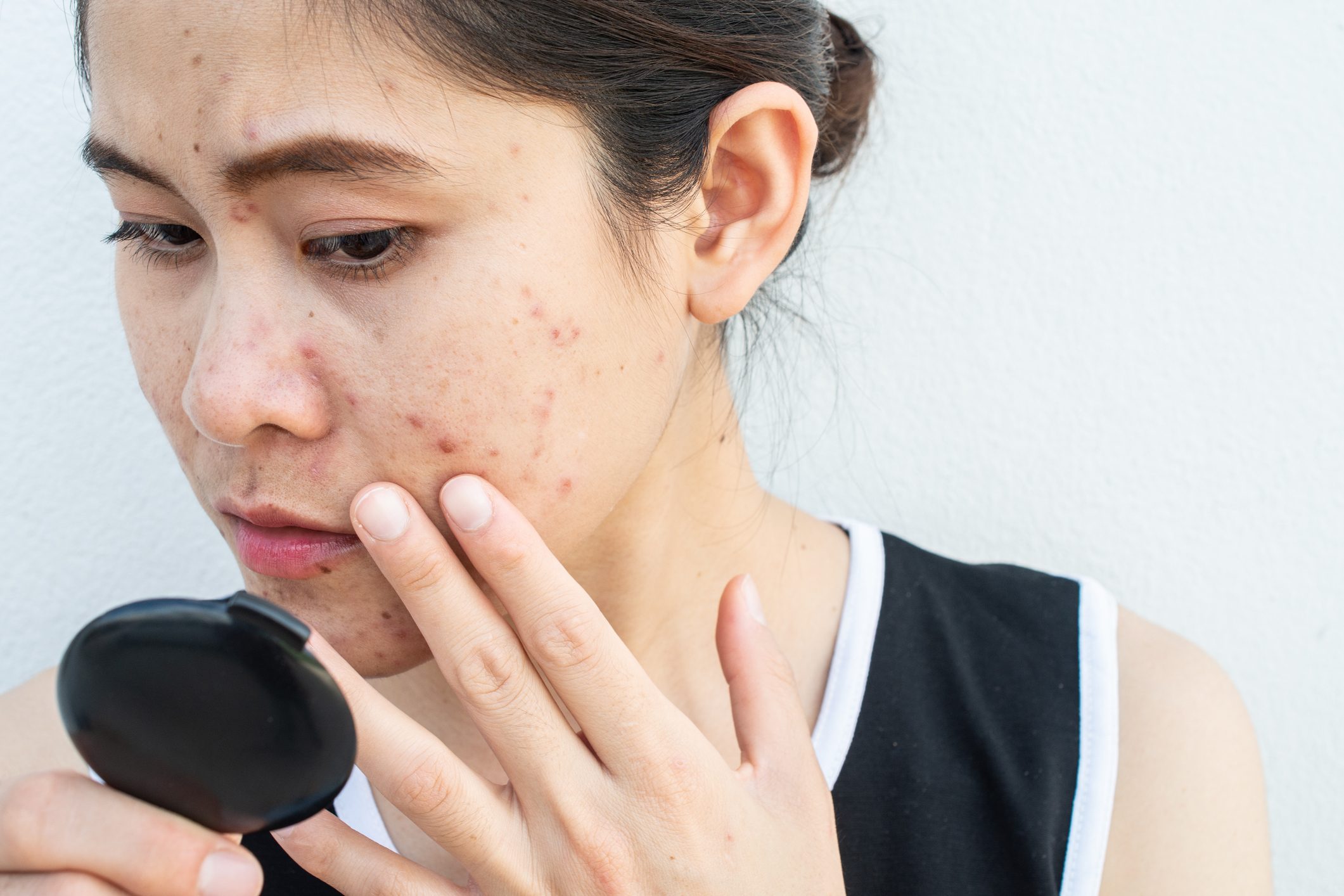 9 Ways Dermatologists Get Rid of Pimples