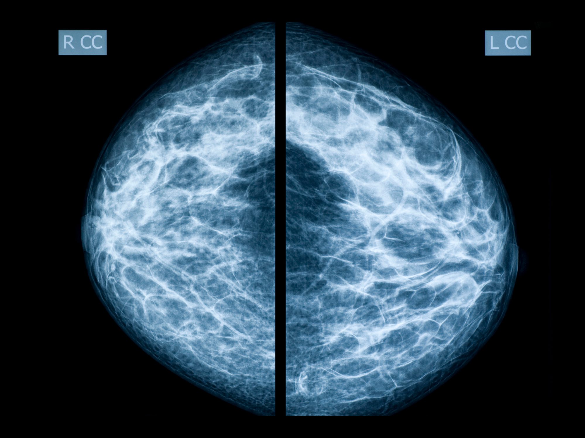 abnormal-mammogram-7-questions-to-ask-your-doctor-the-healthy