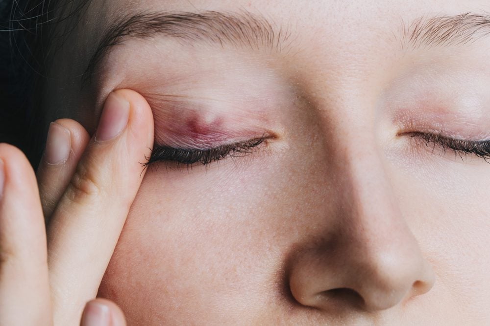 How To Get Rid Of A Stye the Right Way The Healthy