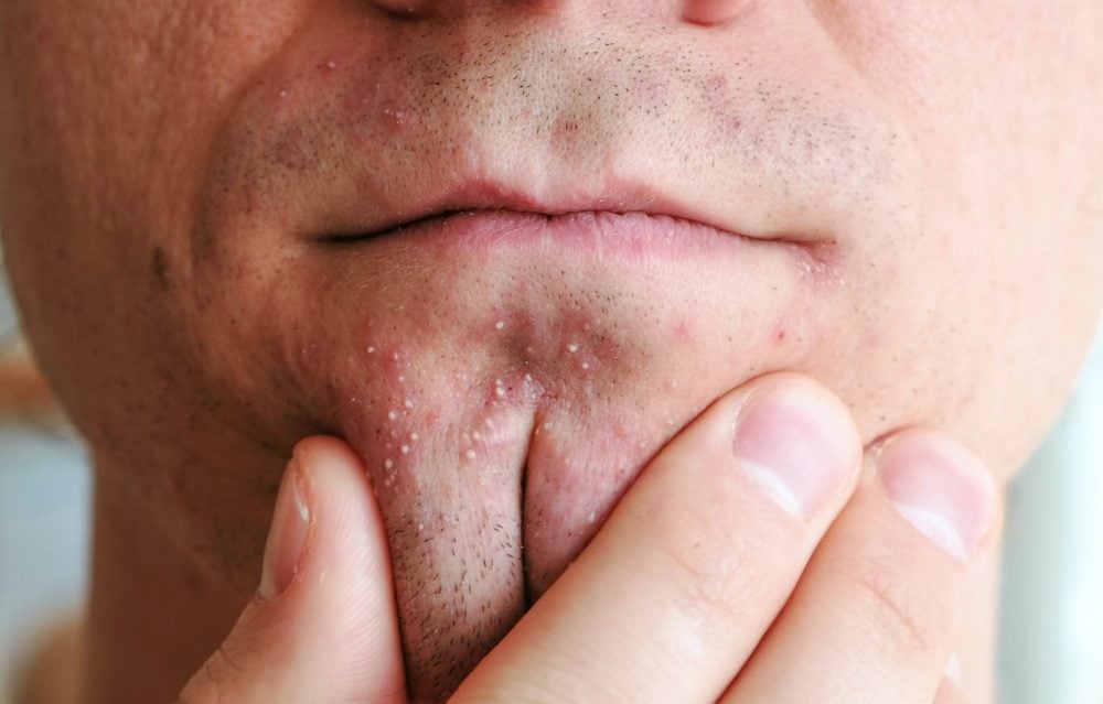 This Is How to Treat Every Type of Acne