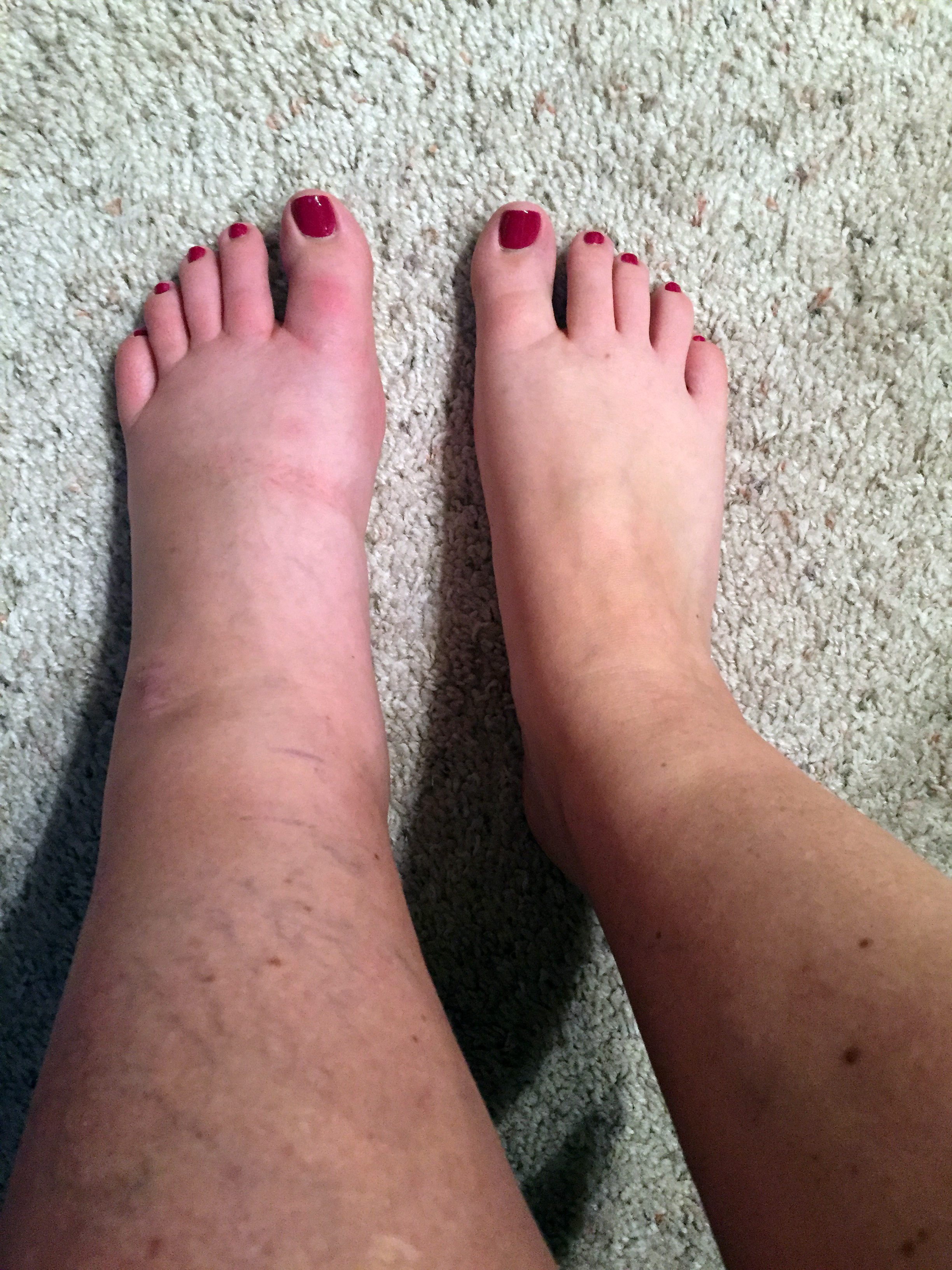 swollen foot