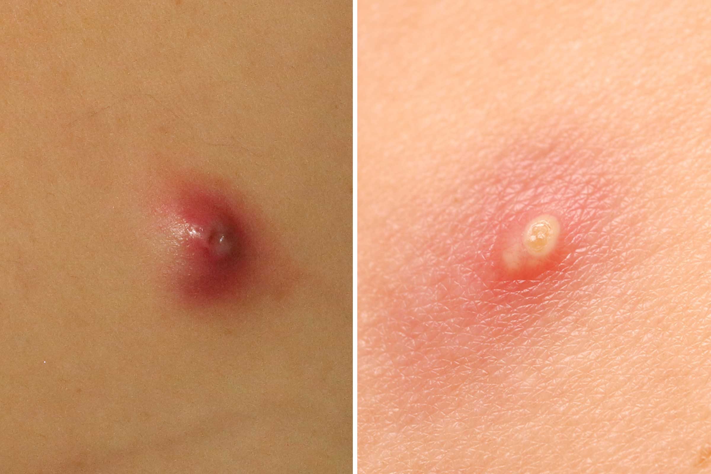 This Is the Difference Between a Pimple and a Boil