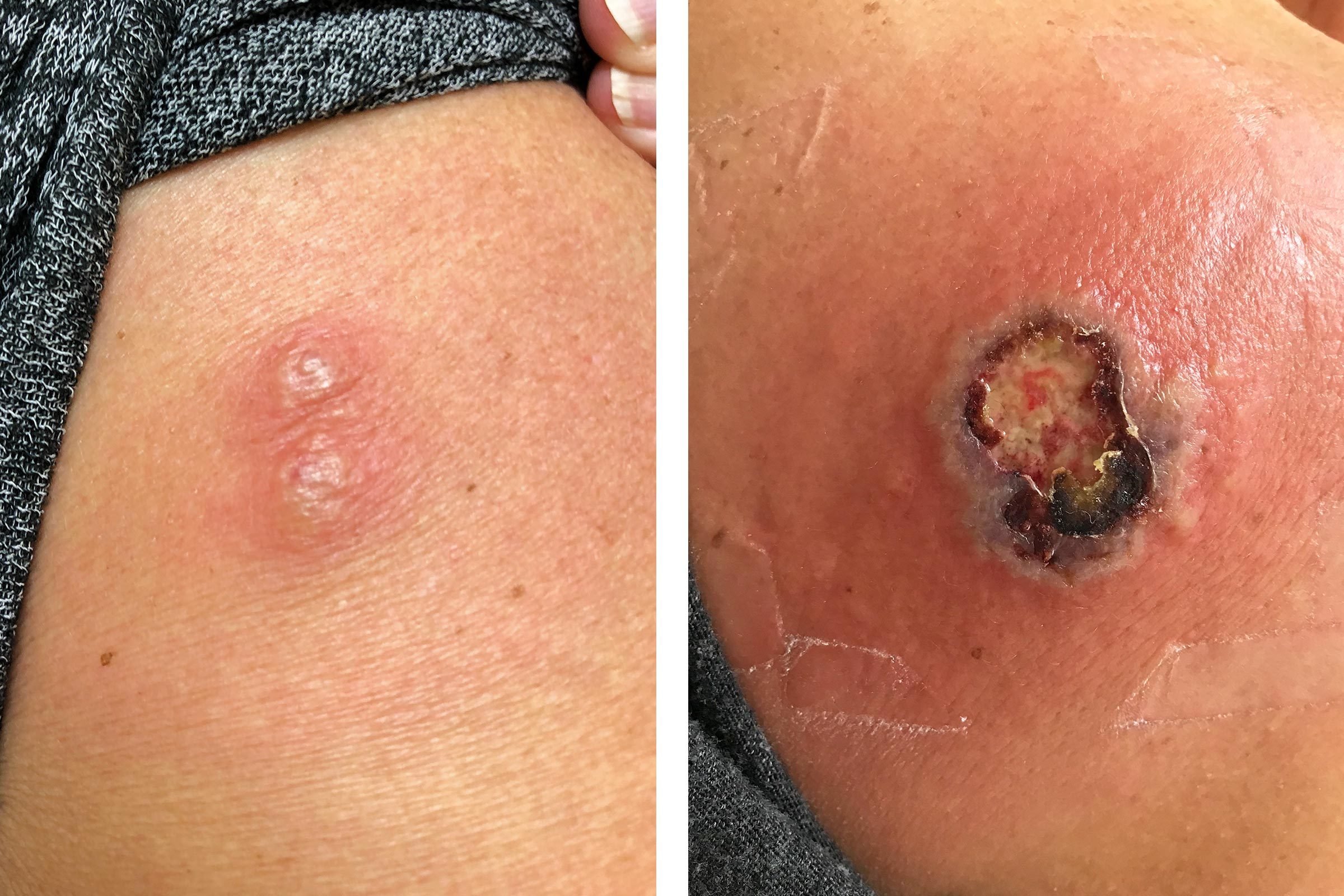 How One Woman Almost Died from Two "Spider Bites"