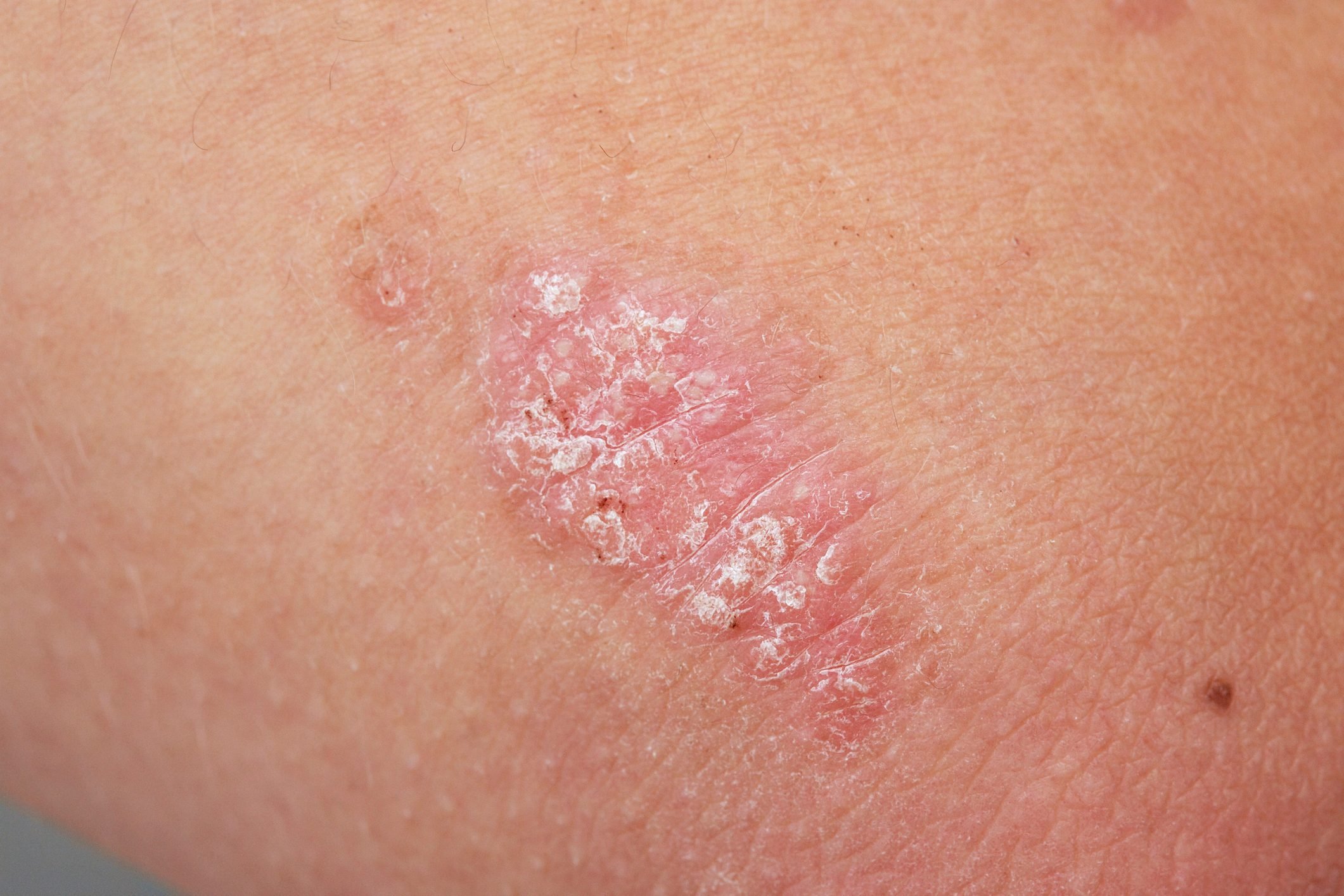 psoriasis on skin