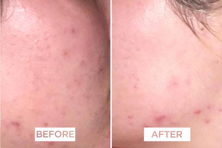 How I Cured My Cystic Acne in 3 Weeks
