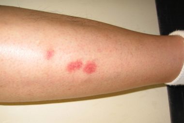 Bug Bite Symptoms You Should Never Ignore | The Healthy