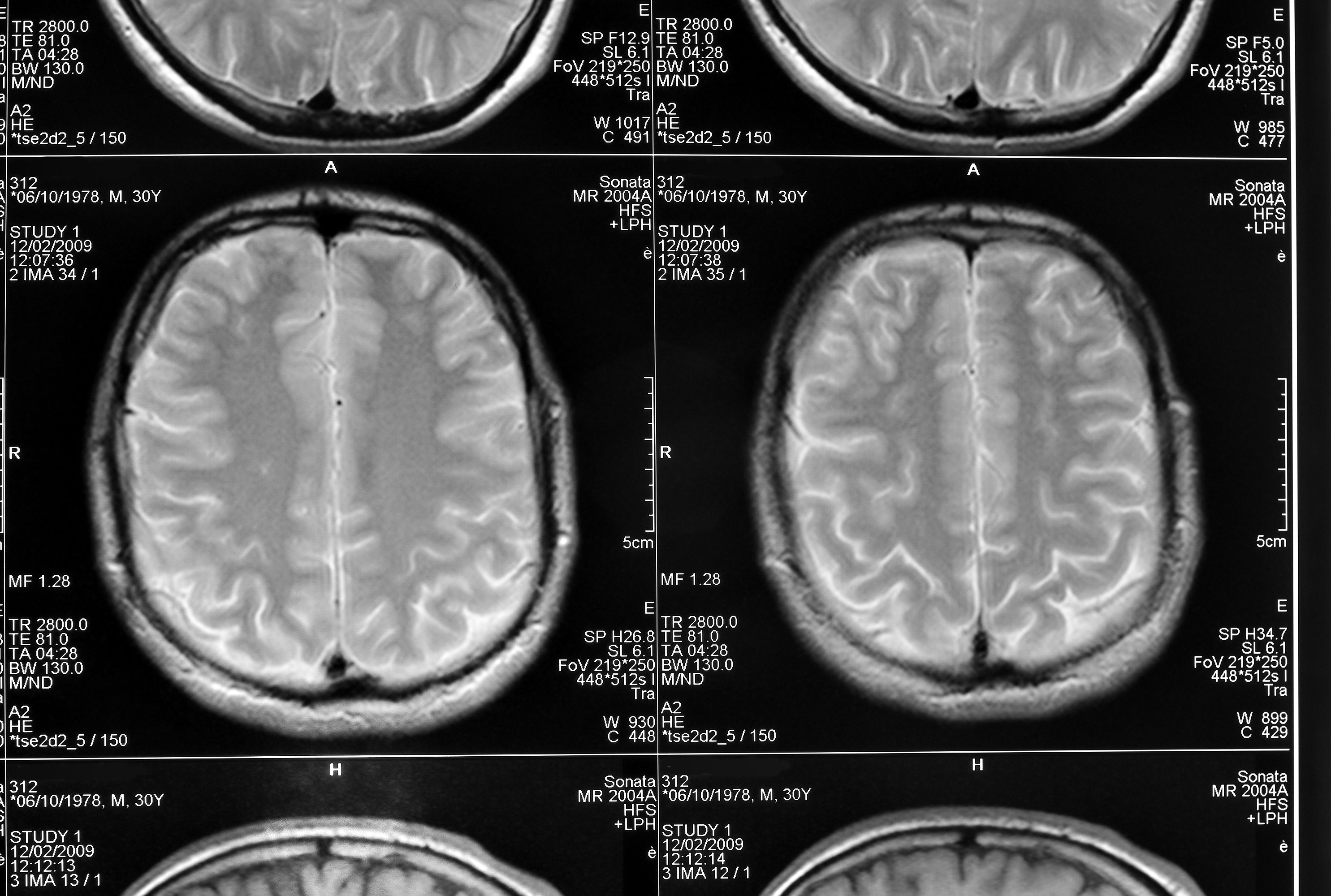 black and white head magnetic resonance image