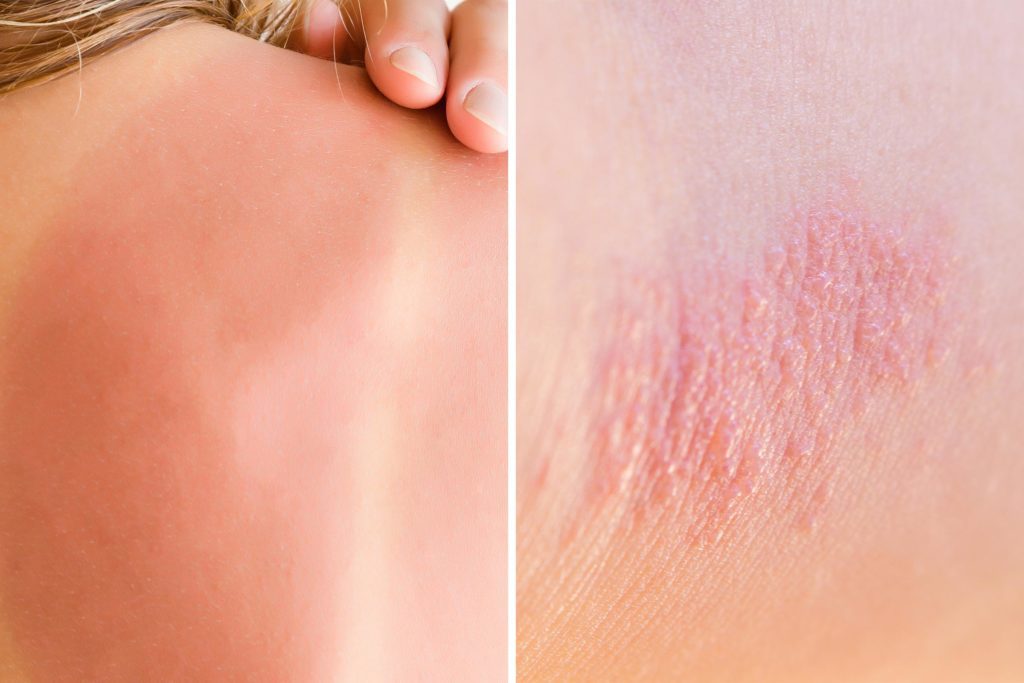 Heat Rash Or Sunburn Here S How To Tell The Difference The Healthy