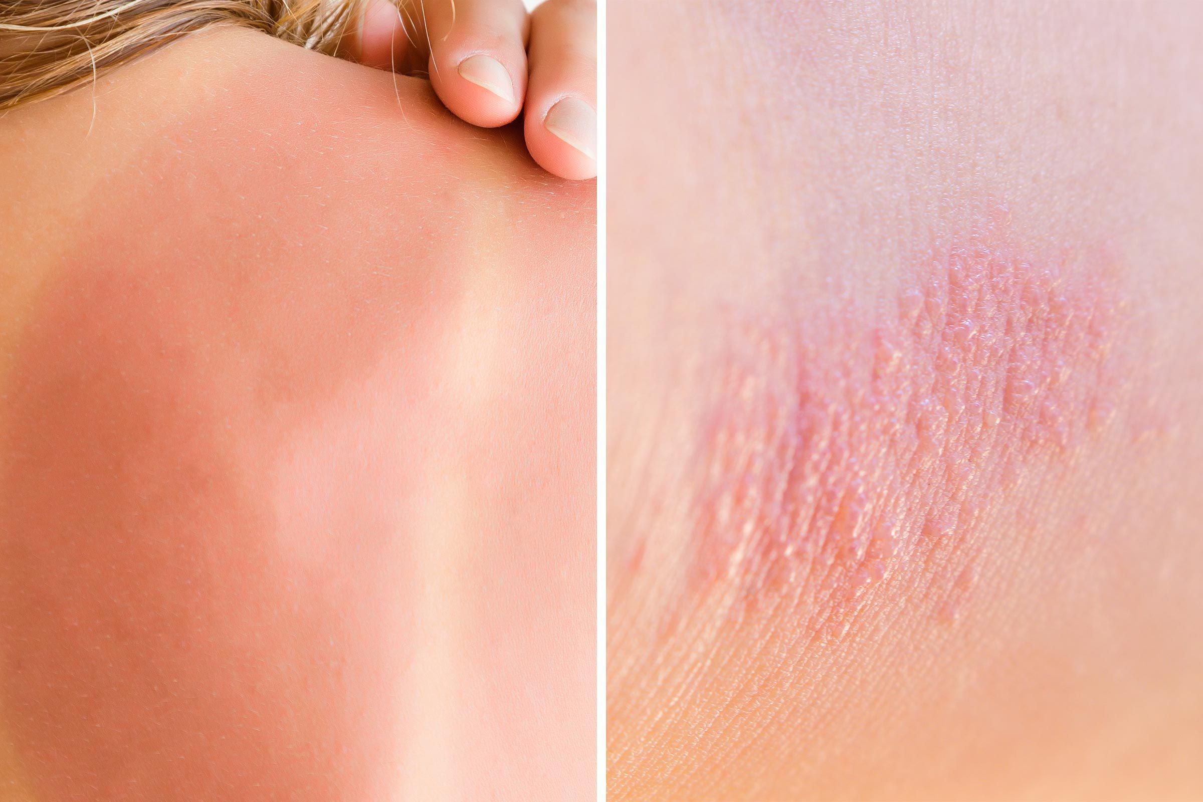 Heat Rash or Sunburn: Here’s How to Tell the Difference