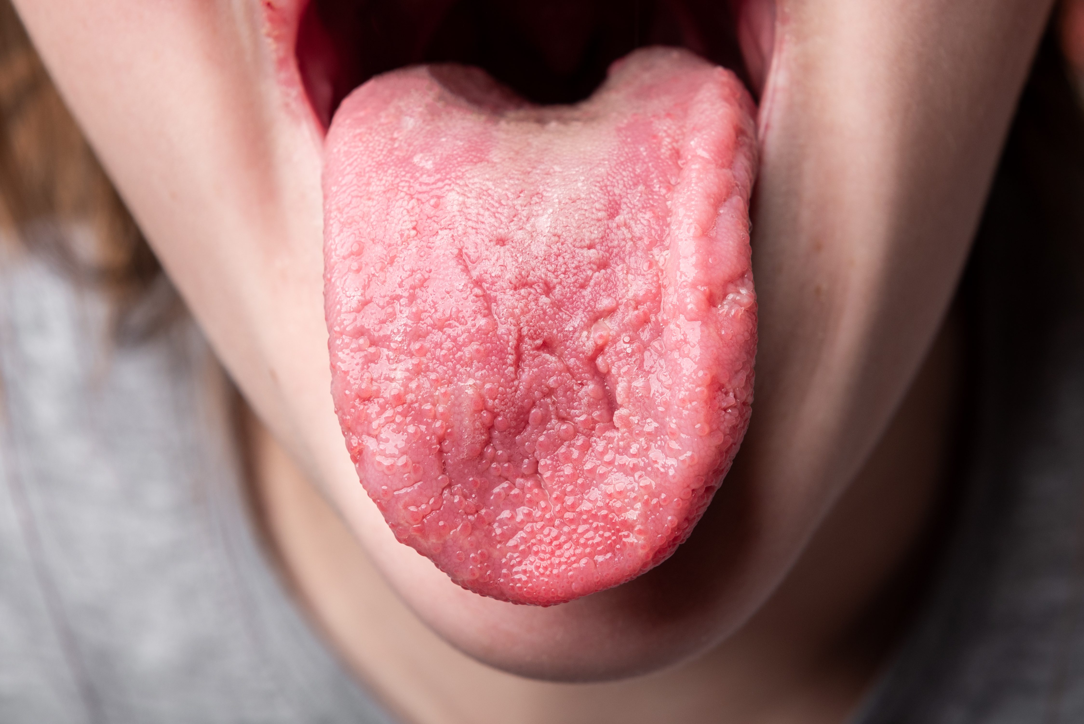 9 Health Clues Hiding Right on Your Tongue