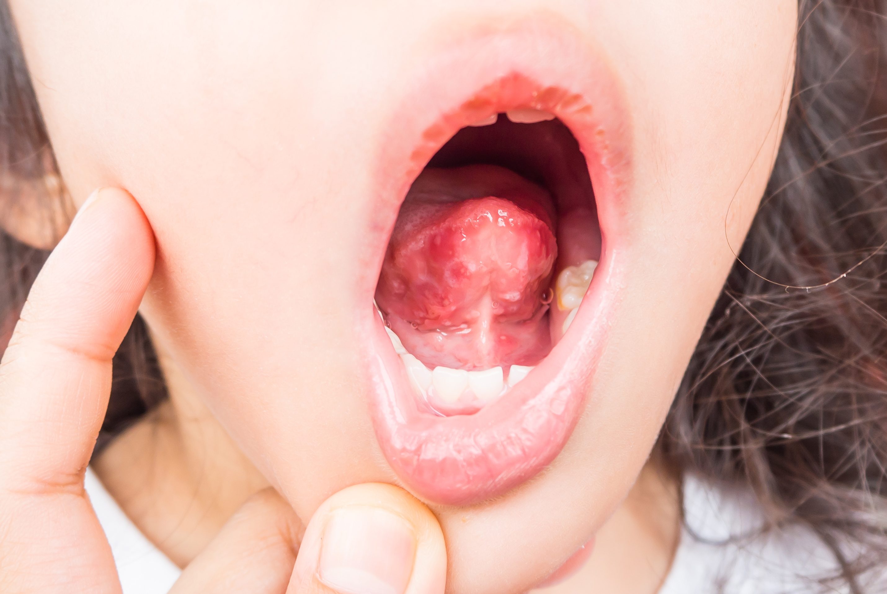 Little white bump under tongue? : r/DentalHygiene