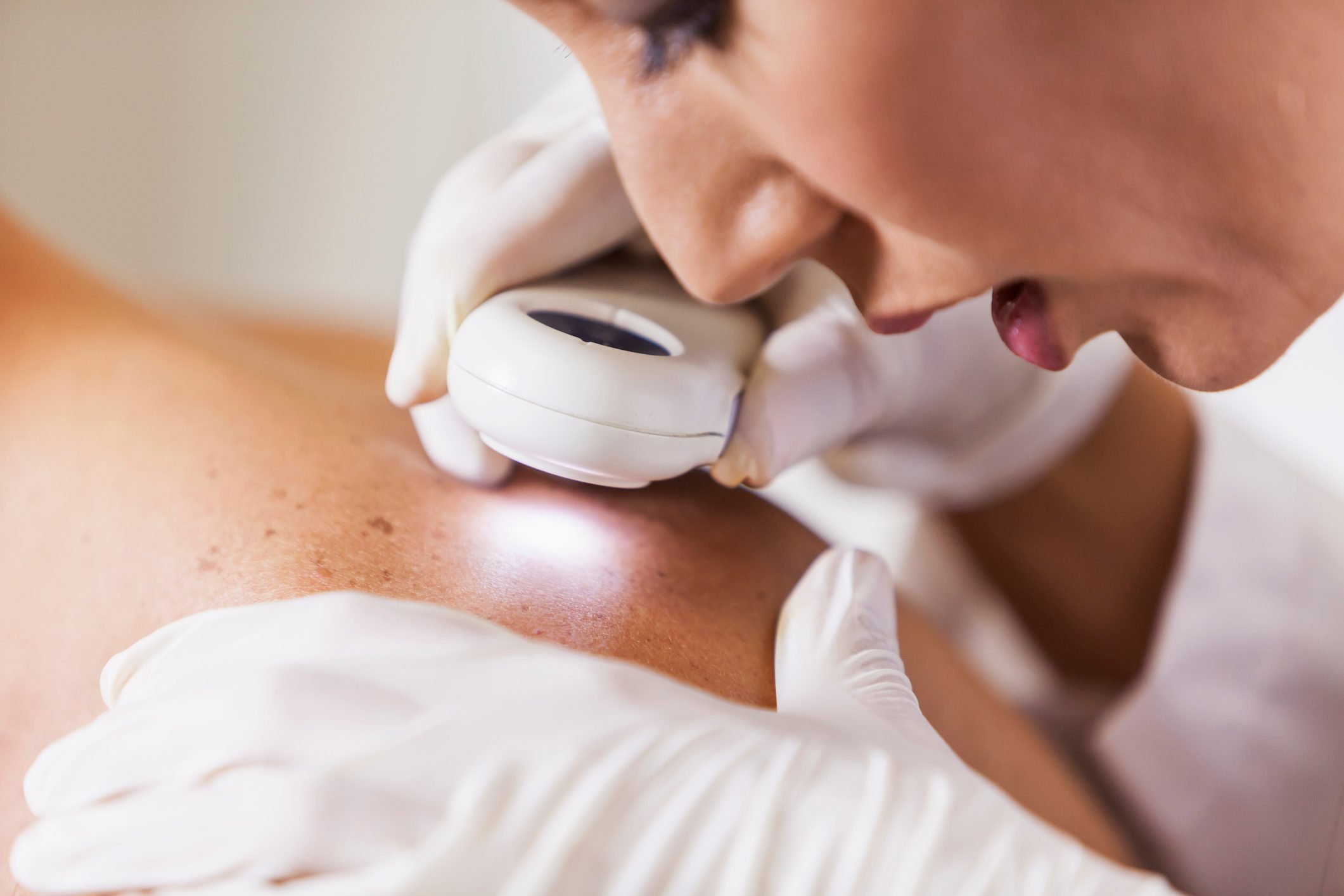 dermatologist examining patient for skin cancer