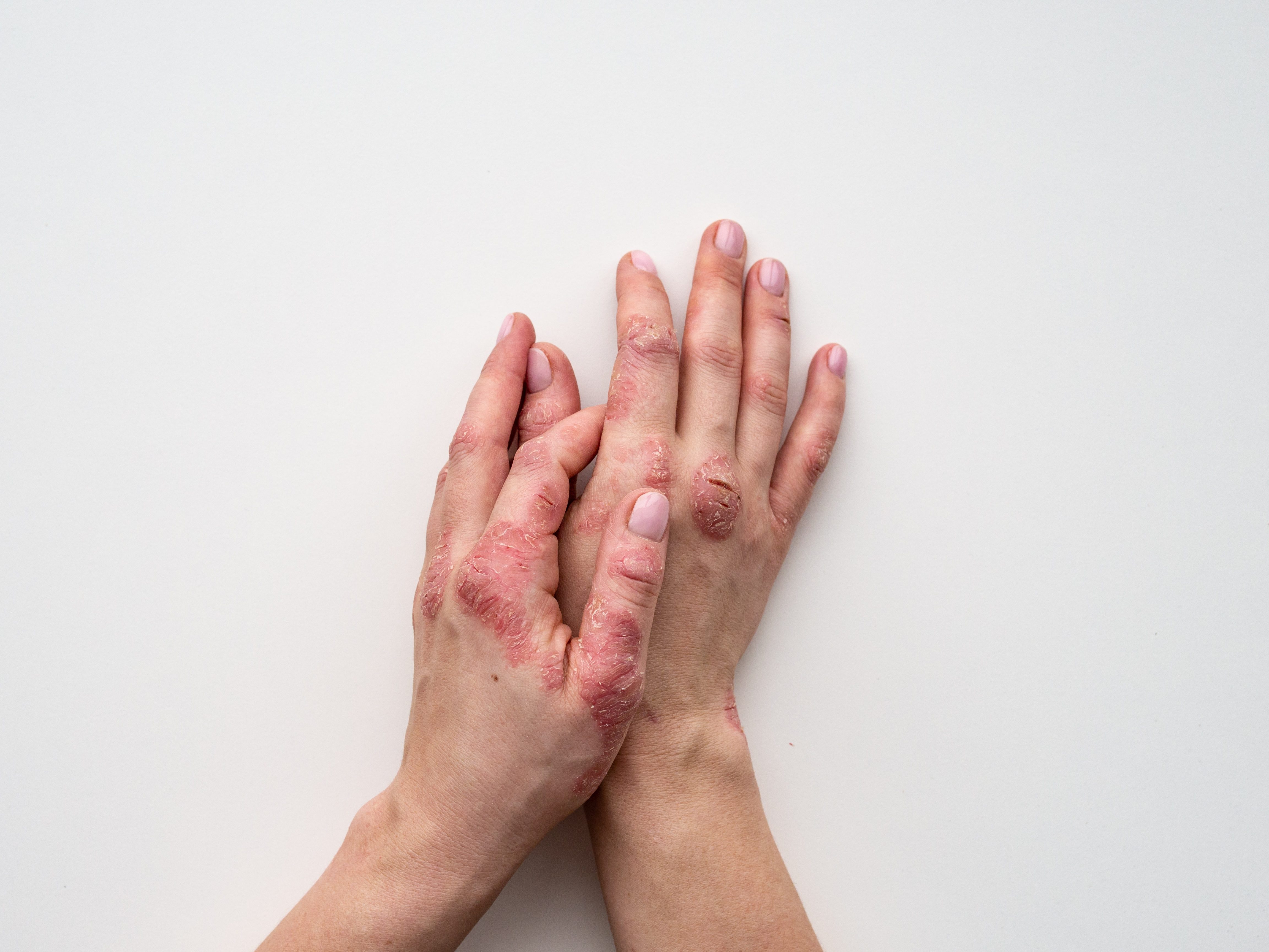 How I Treat My Psoriasis: 8 Tips and Tricks Real People Use