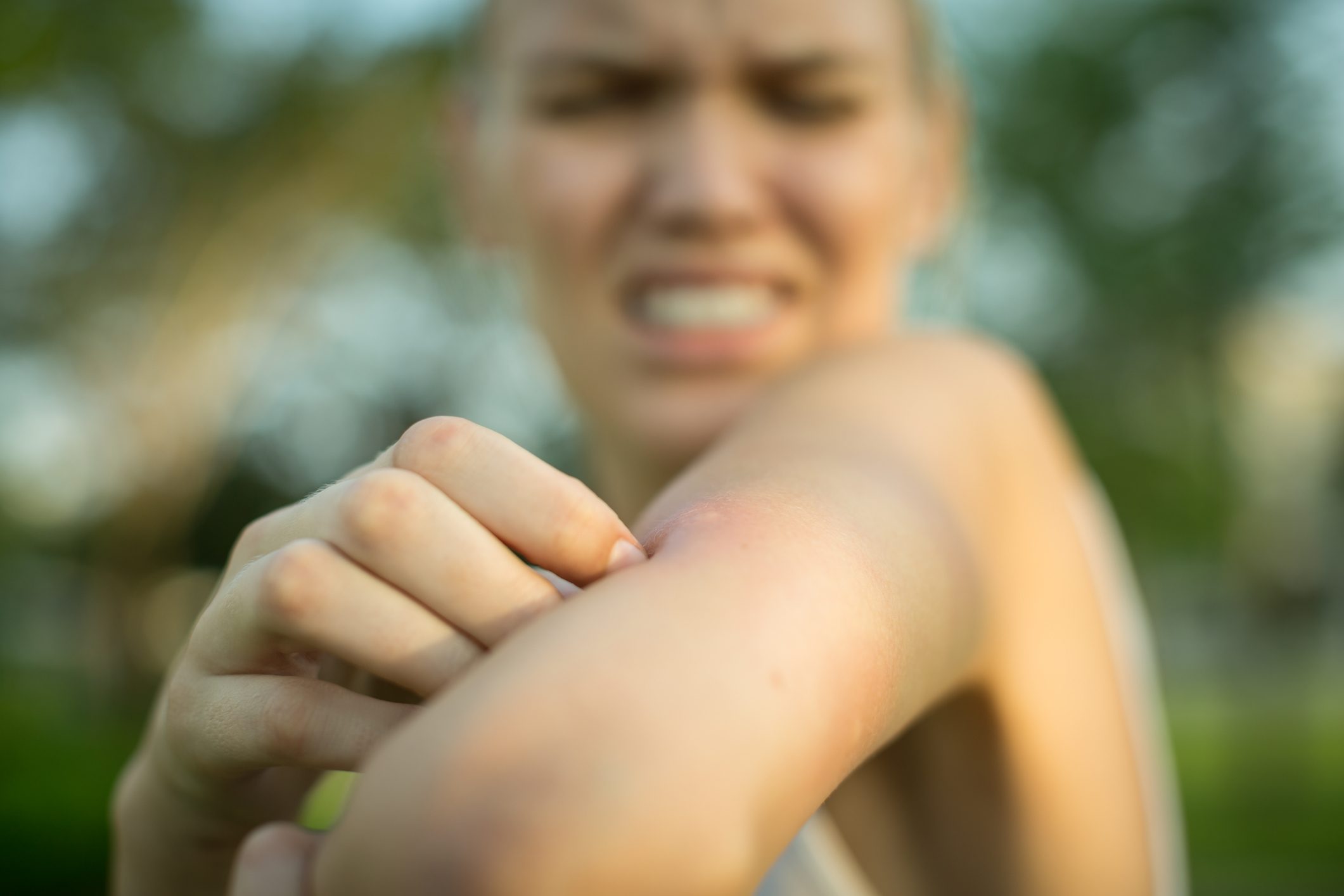 Here's How to Tell the Difference Between a Chigger Bite and a Mosquito Bite