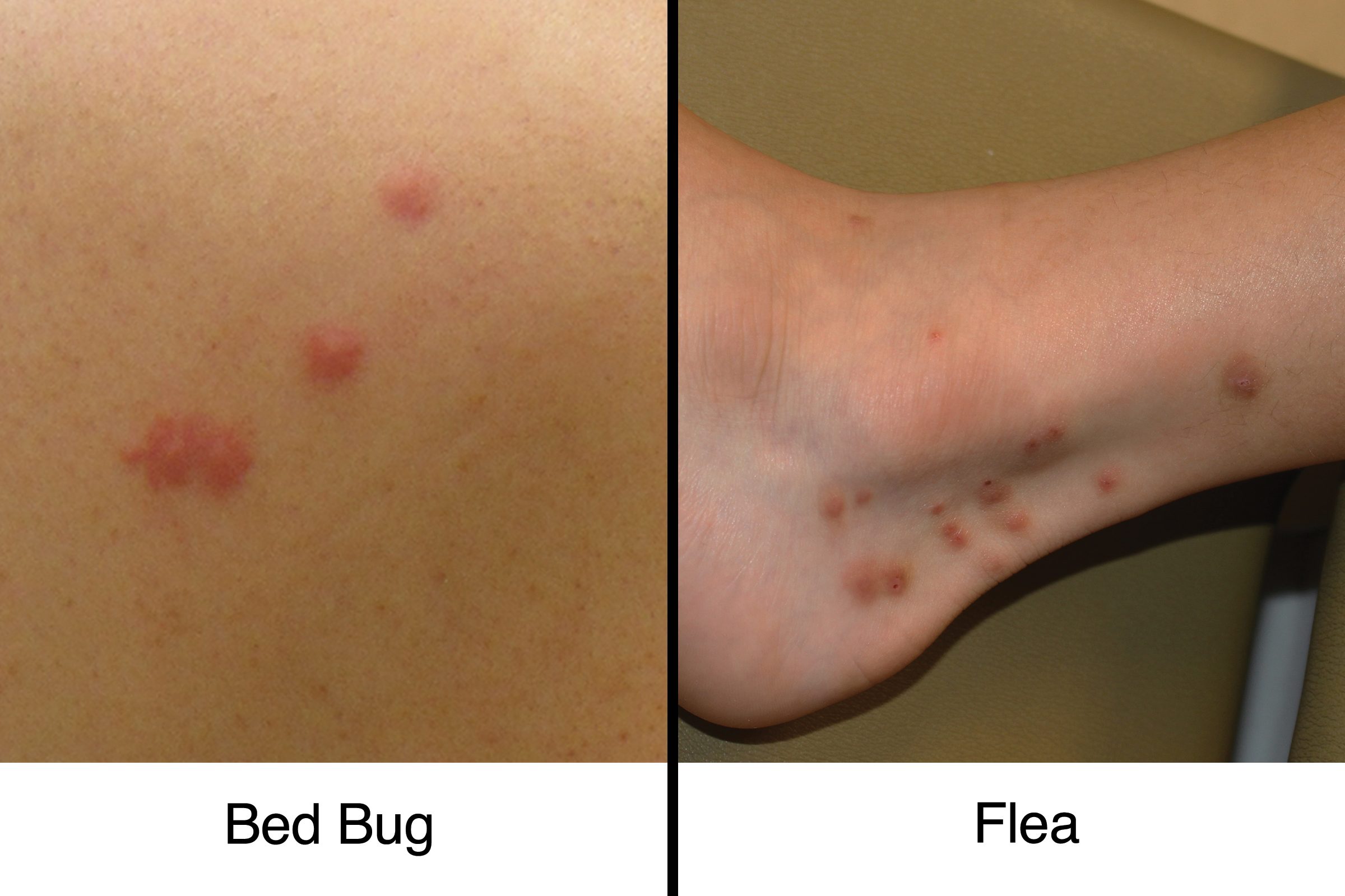 Carolina Pest, Bed Bug Bites vs. Mosquito Bites: How to Tell the  Difference