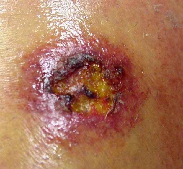 Spider Bite Pictures - What They Look Like, How To Treat Symptoms