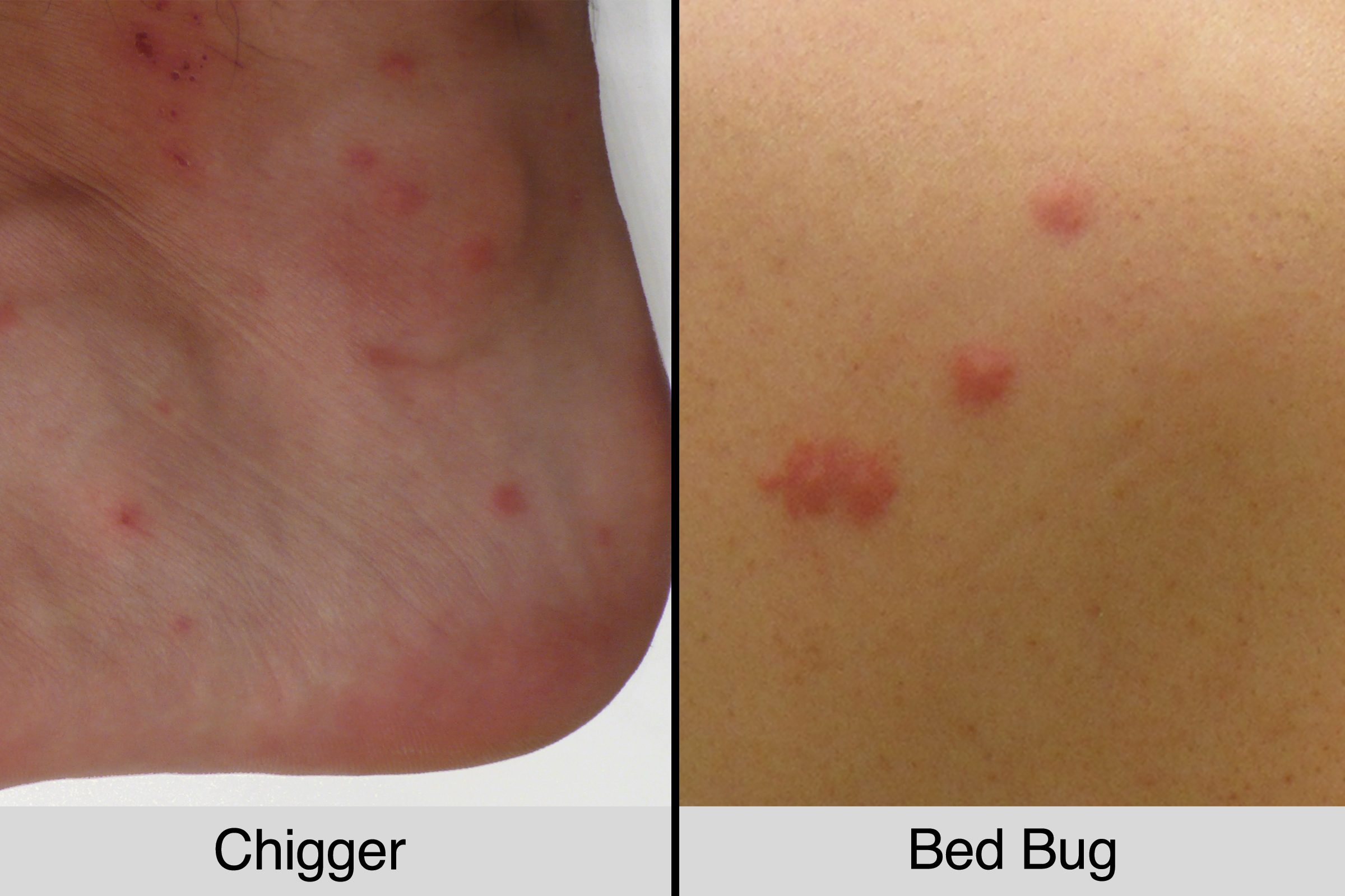 chigger bites vs bed bug bites