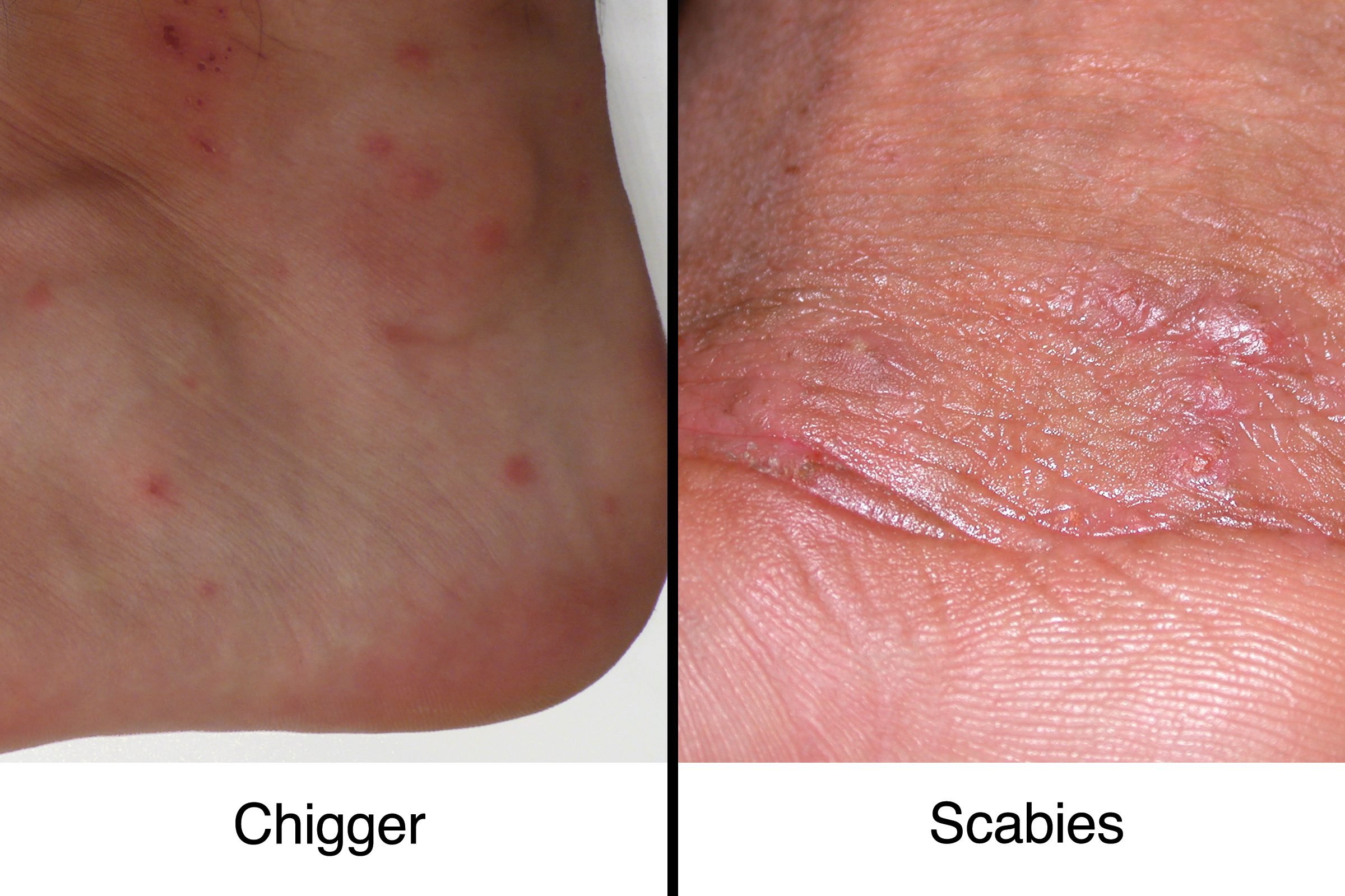chigger bites vs bed bug bites