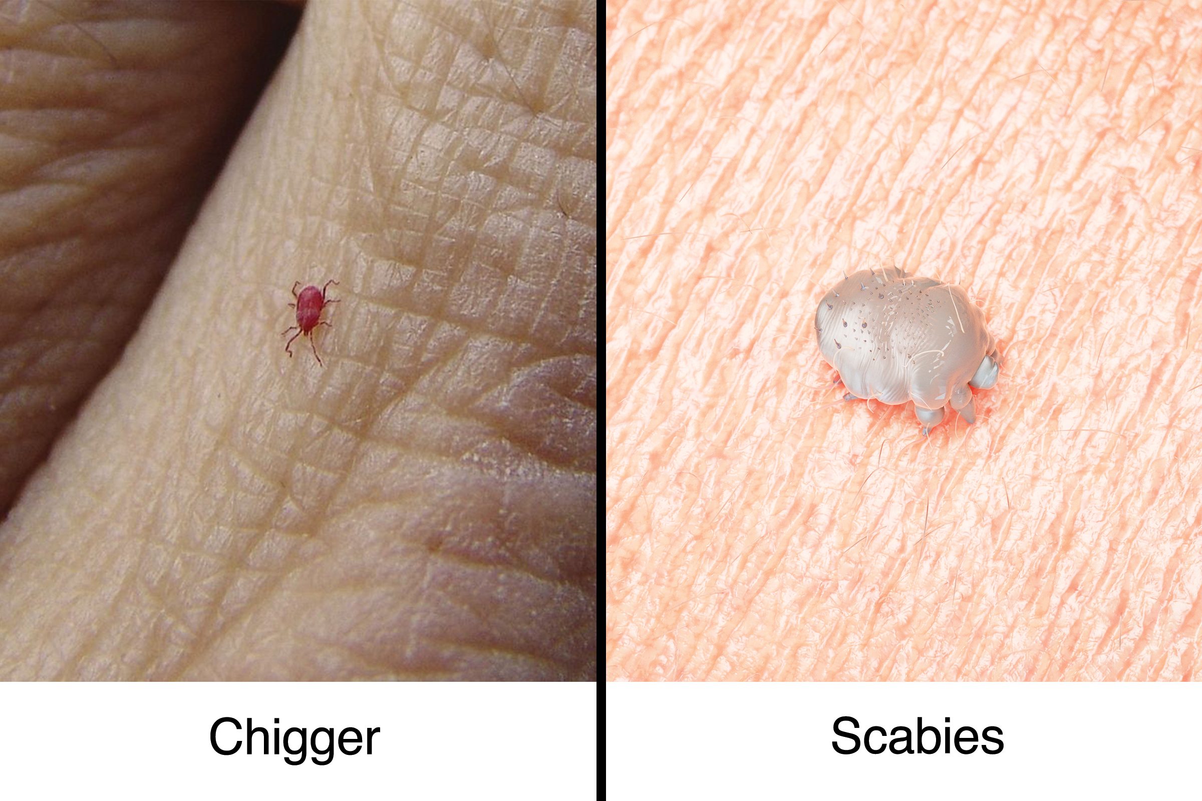 Chigger Vs Scabies ?resize=2048