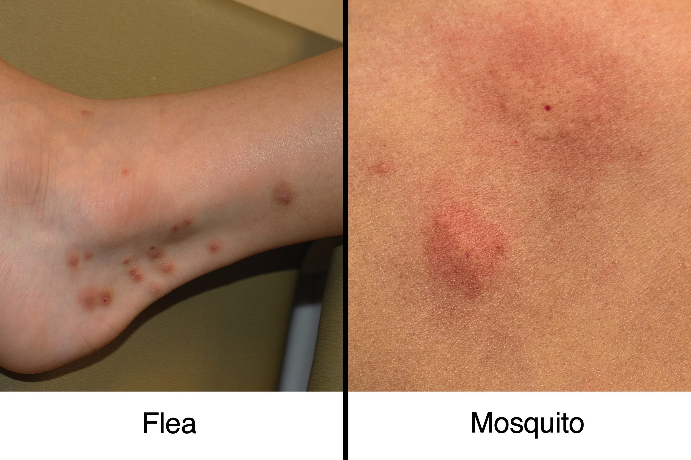 fleabite vs. hyttysenpurema