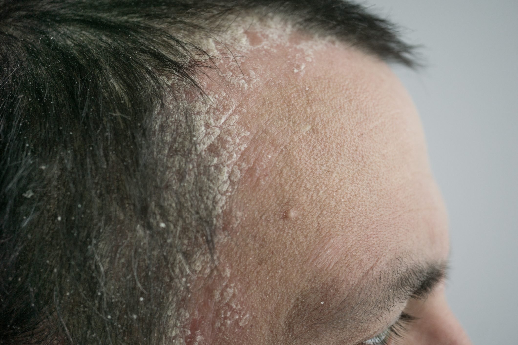 Scalp Psoriasis: You Knew | The Healthy