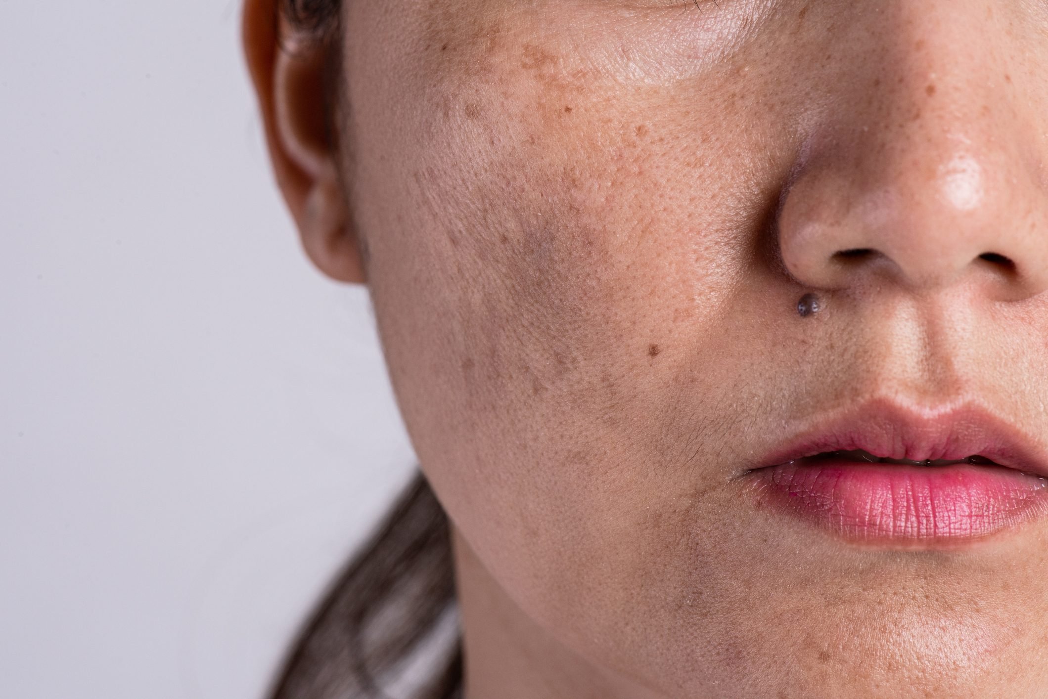 What is Hyperpigmentation? What to Know About Dark Spots and Skin Discoloration