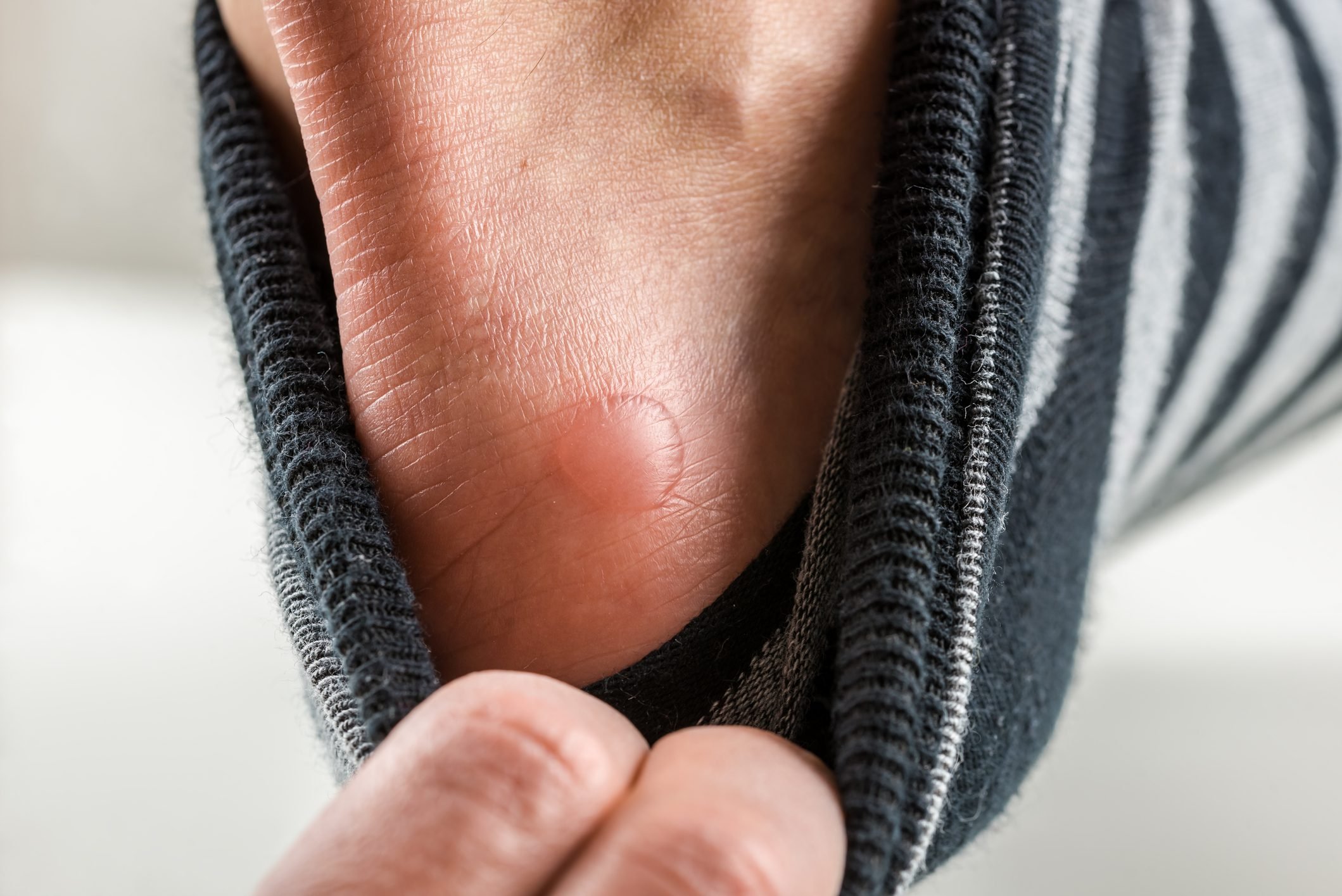 Friction Blisters Here s How To Prevent And Treat Blisters The Healthy